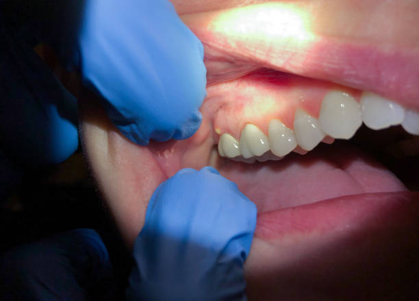 Best Urgent Tooth Repair  in Walton Hills, OH